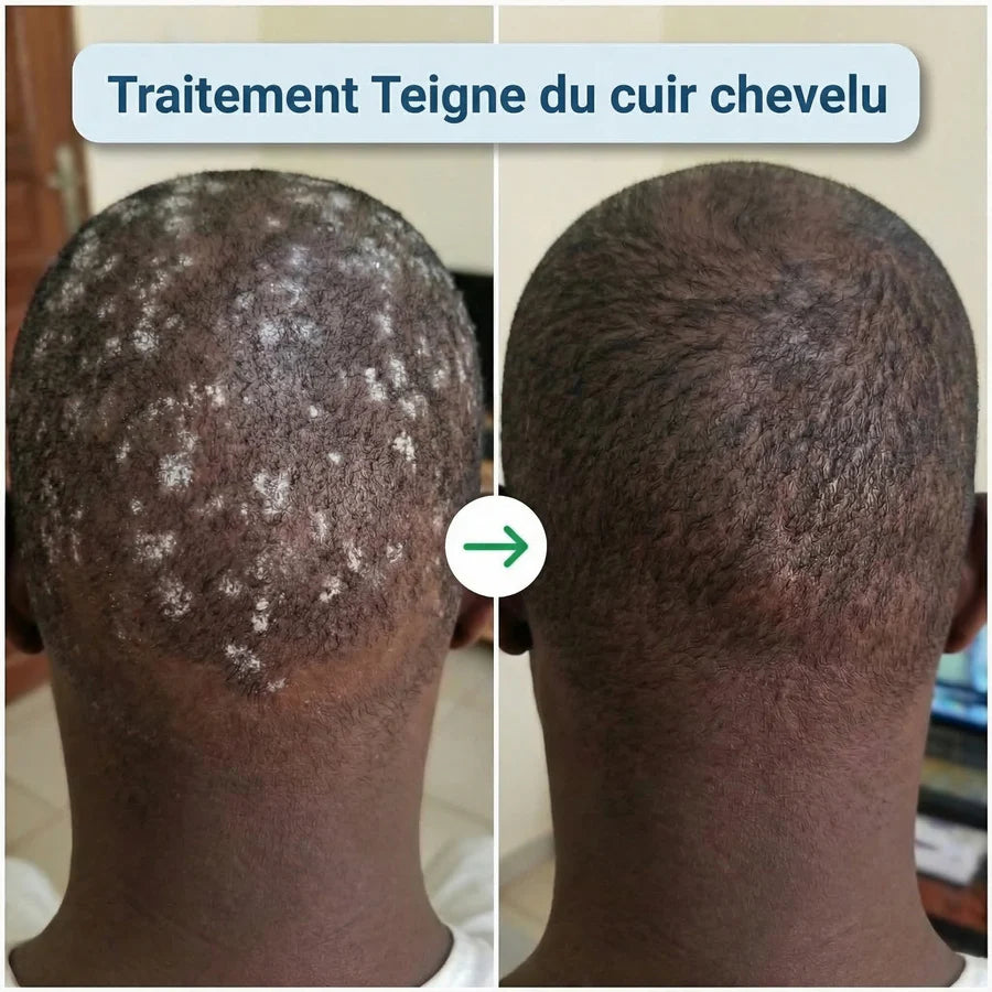 CRÈME TRAITEMENT POUR LA PEAU